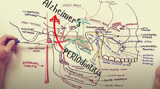 The Microbial Infectious Hypothesis of Alzheimer's