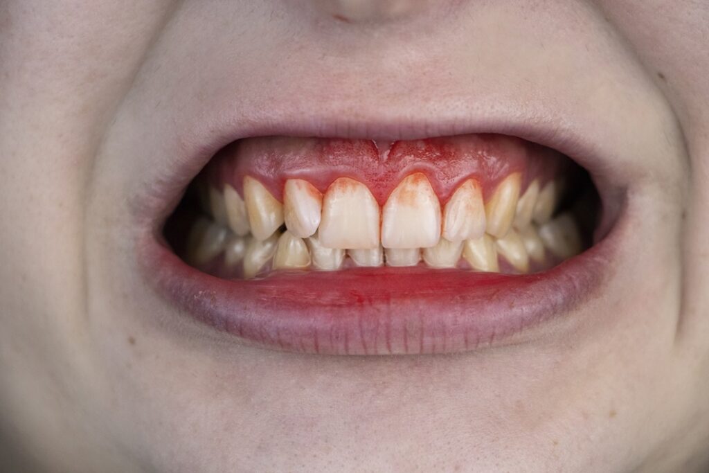 image of bleeding gums